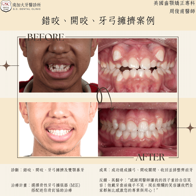 錯咬、開咬、牙弓擁擠案例