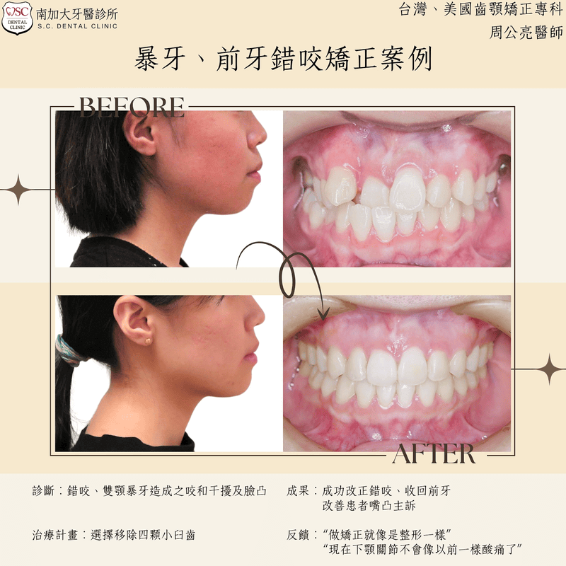 暴牙、前牙錯咬矯正案例