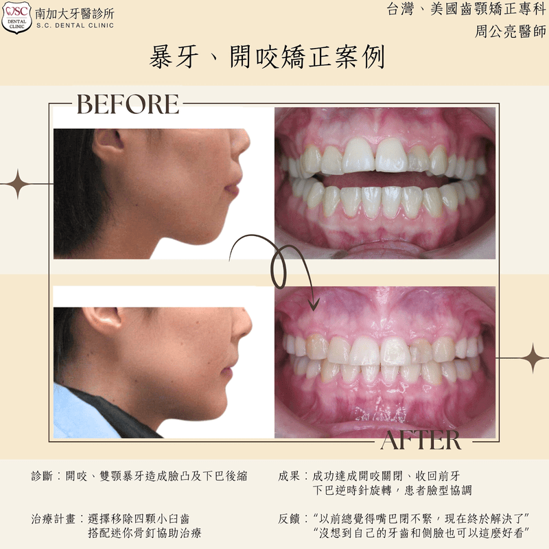 暴牙、開咬矯正案例